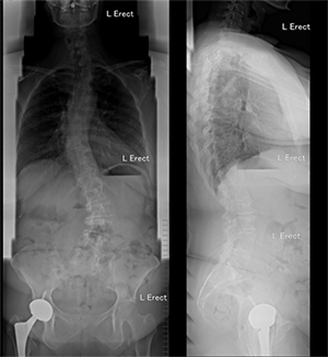 DSDS technique xray