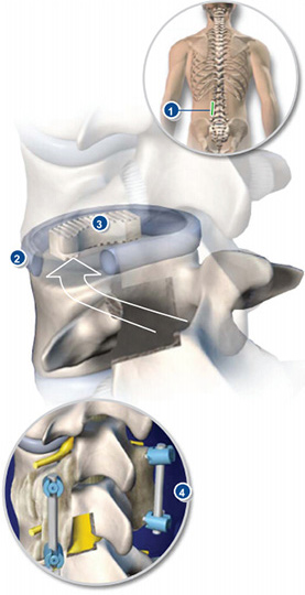 Fact Sheet Transforaminal Lumbar Interbody Fusion