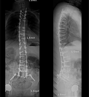 DSDS technique xray